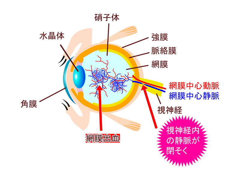 網膜静脈閉塞症